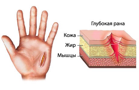 Кровотечения от гинкго